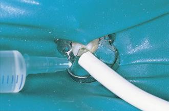 agents Use rubber dam even for subgingival preparations Save time The few minutes that it takes