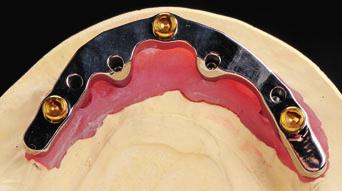 Stefan Holst and DentalX GmbH, Germany. Occlusal view of four implants with ball attachments.