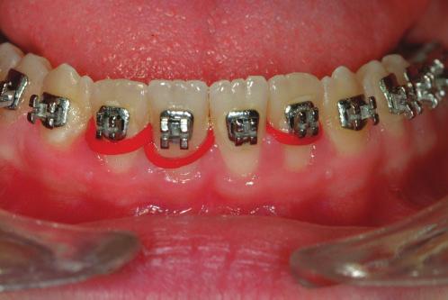 the lingual surface of lower incisors with elastics gingival to the brackets (Figures 4a,b). It is important to stress that the wire must be held passively.