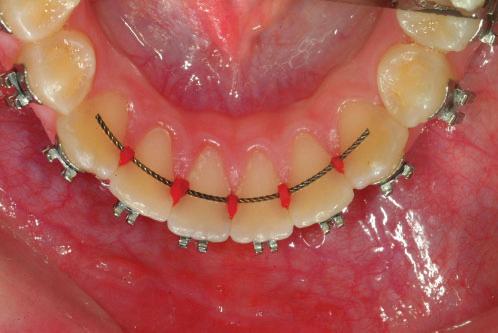 Bonding the retainer Figure 3 (a,b) Placing elastics around incisors We find TransbondH L.C.