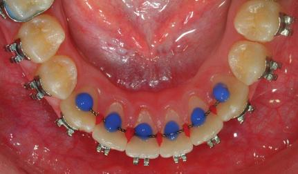A small amount of composite needs to be placed on the lingual surface of lower 3-3 and subsequently cured.