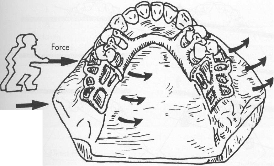 Chapter 8 Indirect retainers 145 movement c movement Fig. 8-1, cont'd Possible rotational movement distal extension partial denture in function.