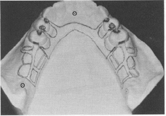 148 McCracken's removable partial prosthodontics :fig. 6-4 Planning location for indirect retainers for Class I partial denture.
