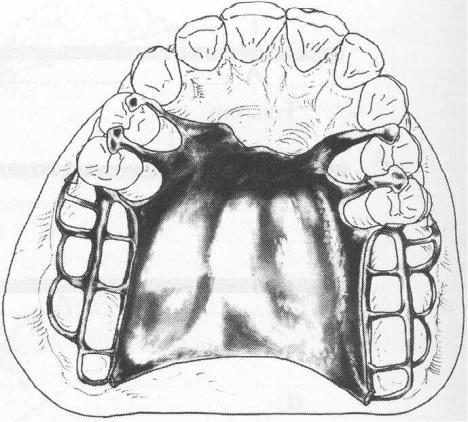 Proximal plates and dual occlusal rest!; on prepared rest seats at mesial marginal ridge first premolars provide effective indirect retention with optimum tooth support Fig.