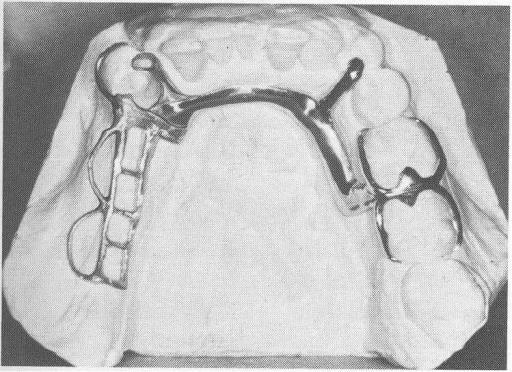 Chapter 8 Indirect retainers 149 Fig. 8-6 Mandibular Class II design using embrasure clasp on right side arch.