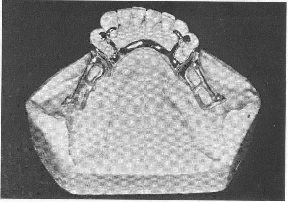 Bar-type retainer could not be used because presence large tissue undercut (buccal) below first premolar and absence usable undercut on its distobuccal surface.
