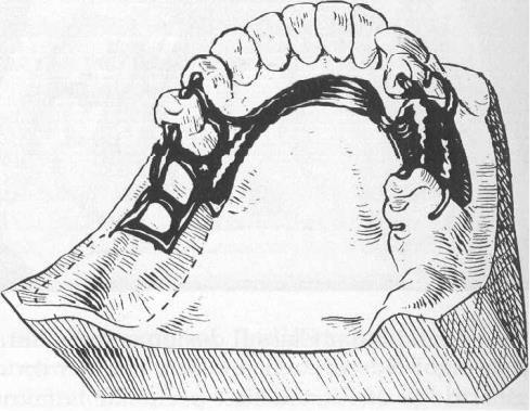 150 McCracken's removable partial prosthodontics the terminal rests at either end in the form auxiliary occlusal rests or canine rests (see Chapter 5).