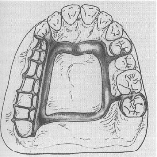 Fig. g.9 Clagg II maxillary removable partial denture framework de"ign. Fulcrum line run" from p"tient'" right canine to left second molar.