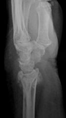 patient usually satisfied JBJS 2006 81 y/o woman s/p fall on dominant wrist Management?