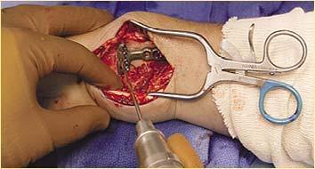 Self retainer stretching the median nerve in ulnar