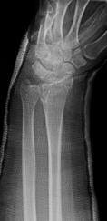 Vote with your hands 46 y.o. F dentist (needs both hands) with comminuted, intra-articular fracture of her non-dominant wrist Concerns: continued settling radial shortening, DRUJ