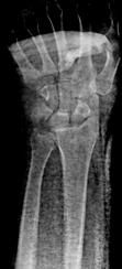 intra-articular fracture