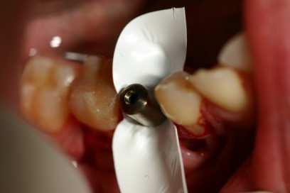 Anatomically buccal bone plat of the teeth is thinner than lingual or palatal.