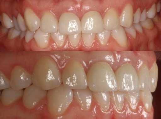 Soft tissue volume is assessed by the quantity of attached gingiva.