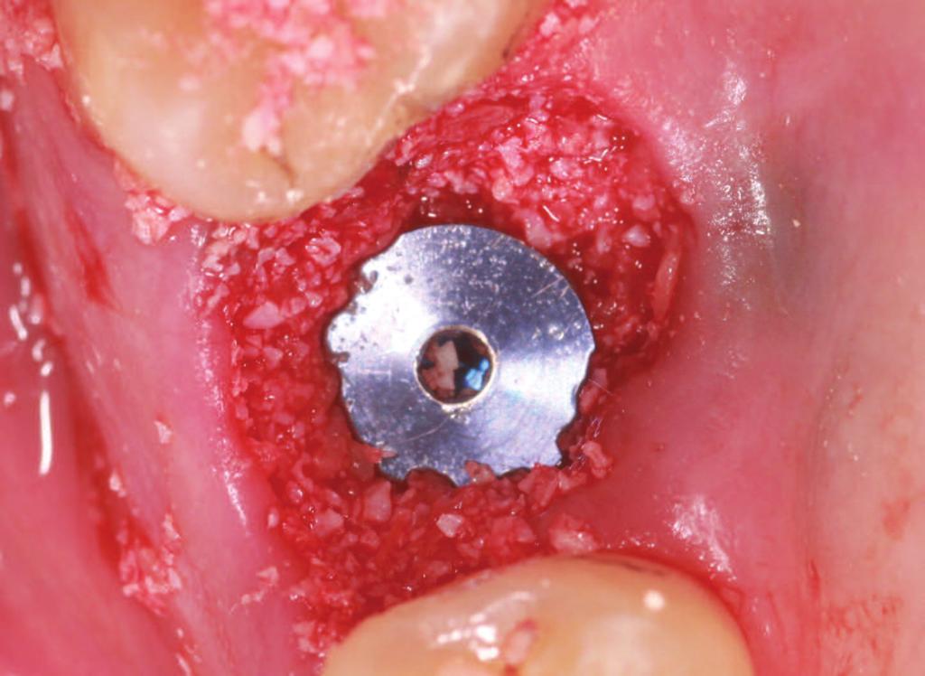 Figure 10 View of final implant position in the extraction socket.