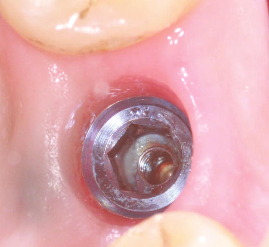 Figure 15 Figures 18 & 18a Healing abutment in place