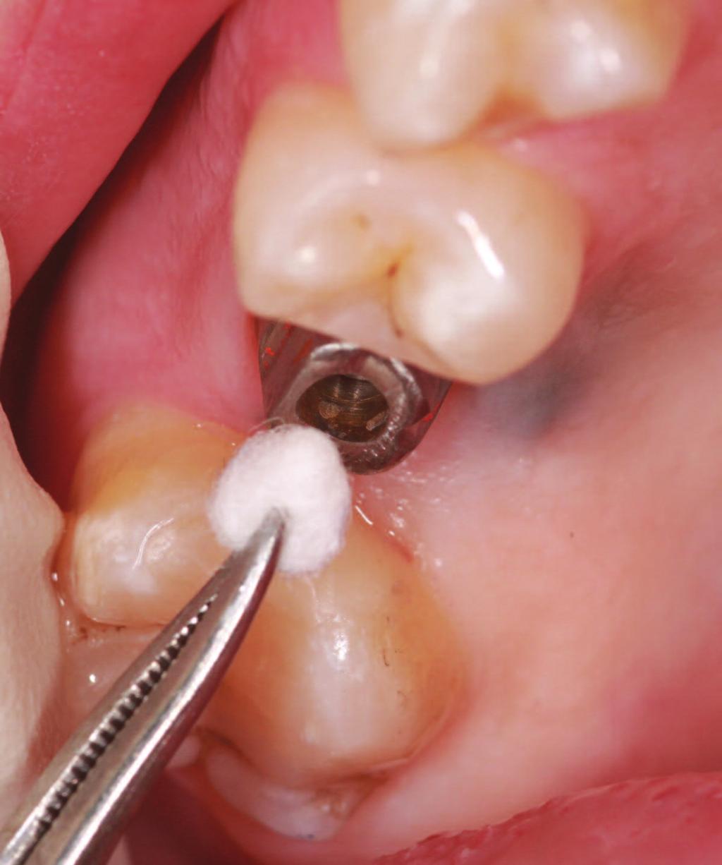 Figure 20 Cotton pellet placed in abutment screw hole to prevent the cement from obstructing access