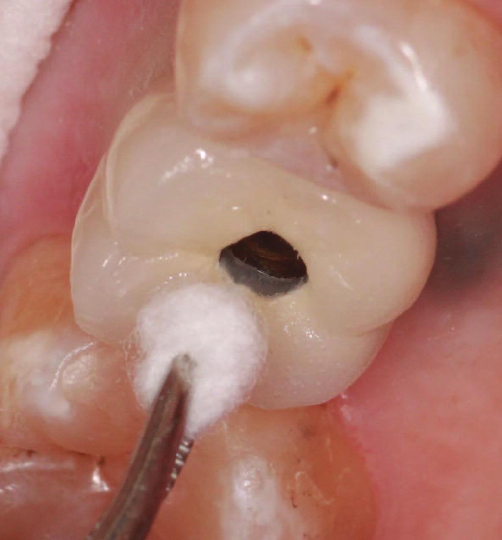 Summary As shown in this case, there are some advantages to following an accelerated implant placement procedure and a simplified prosthetic protocol for screw
