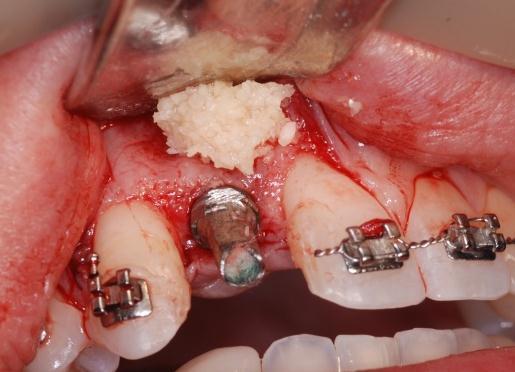 The prepared fixture mount is attached to the implant and its screw access hole is occluded with composite