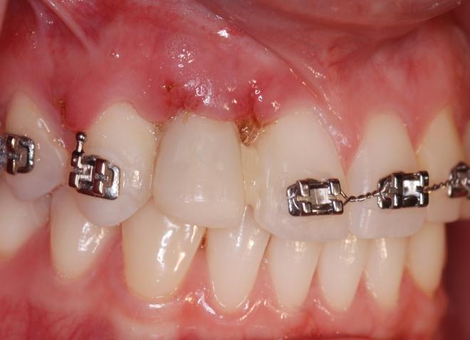 Buccal view of the surgical site at