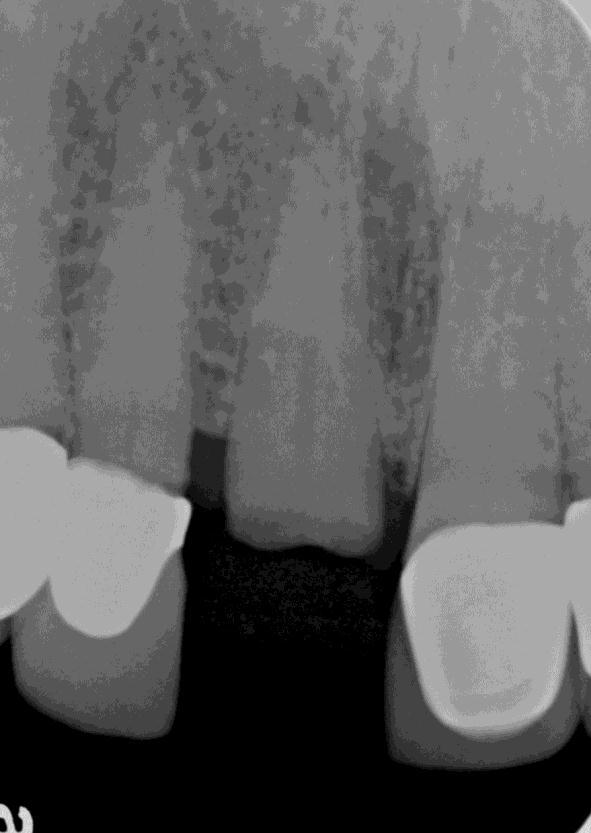 Pre-operative periapical radiograph shows the intact