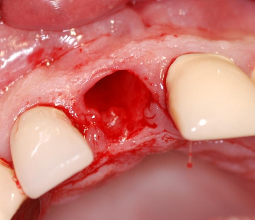 The root tip is gently split and removed in segments to preserve the surrounding bony architecture.