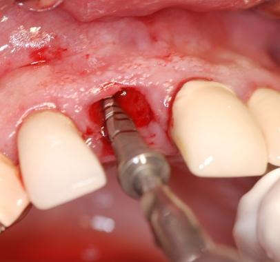 The socket is sequentially formed and enlarged to receive the implant using