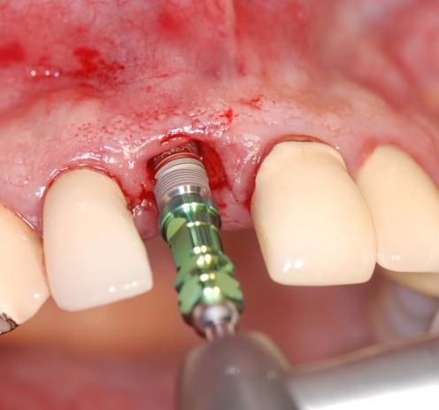 The Zimmer Trabecular Metal Dental Implant is placed using