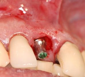 After implant placement, the fixture mount is removed from the implant,