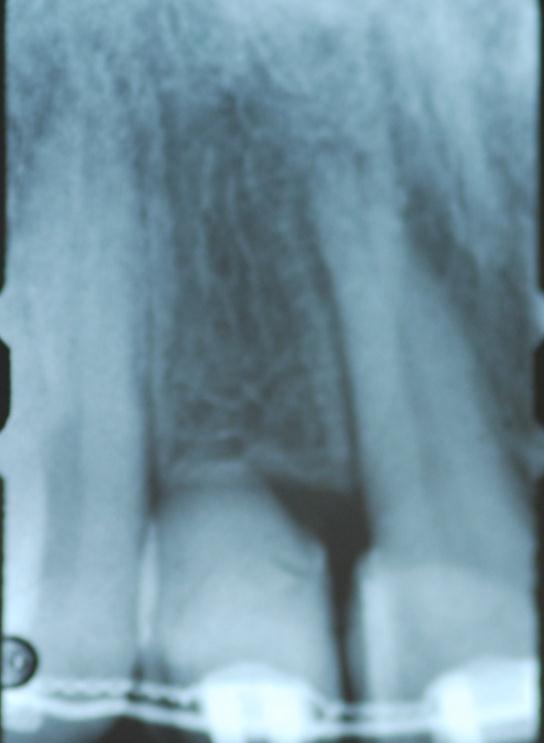 Pre-operative periapical radiograph shows the healed extraction site with