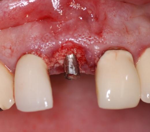 Circumferential voids around the top of the implant are augmented with hydrated Puros Cancellous