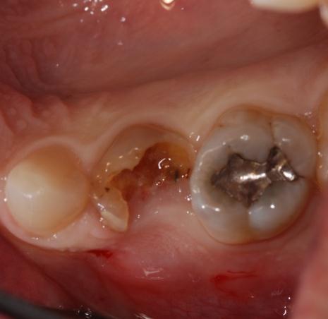 Pre-operative occlusal view shows a