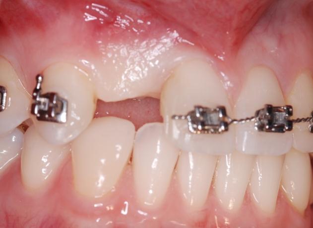 Buccal view of the edentulous site after removing the