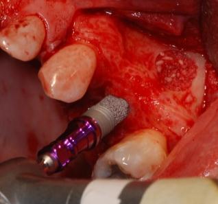 A Zimmer Trabecular Metal Dental Implant, 4.