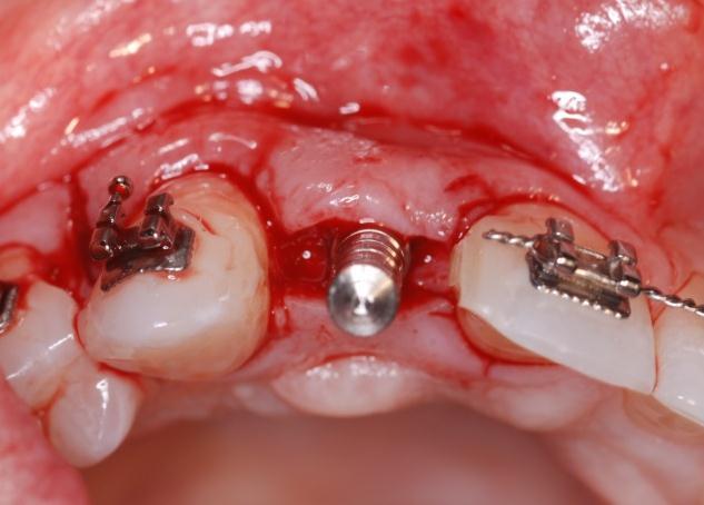 The edentulous ridge is surgically exposed and an osteotomy is sequentially prepared using internally irrigated drills in graduated diameters and copious external