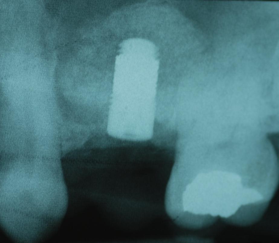 Post-operative radiograph shows the Trabecular