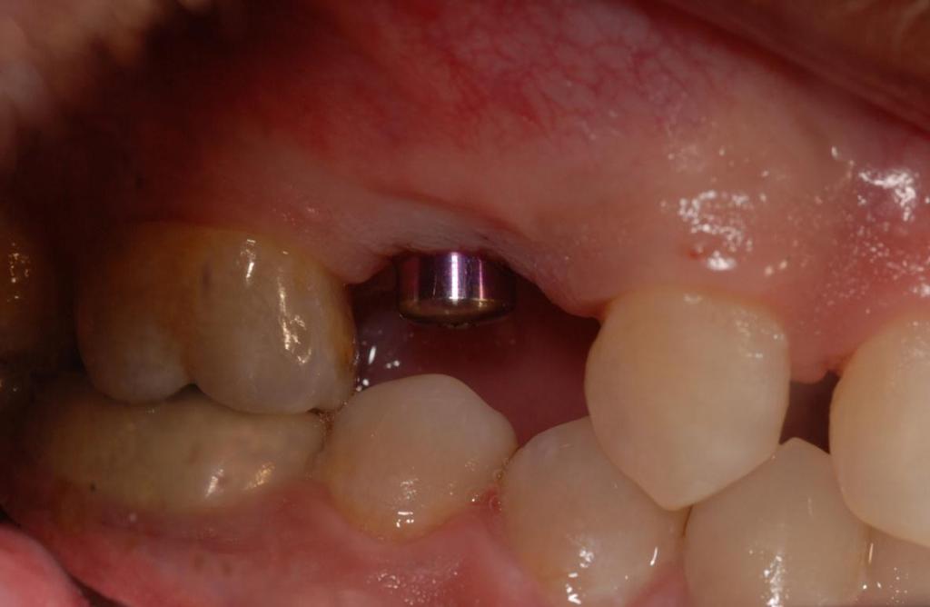 Implant uncovered and