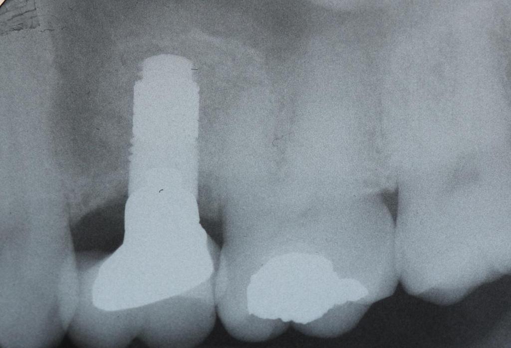 Radiograph of Trabecular Metal Dental Implant