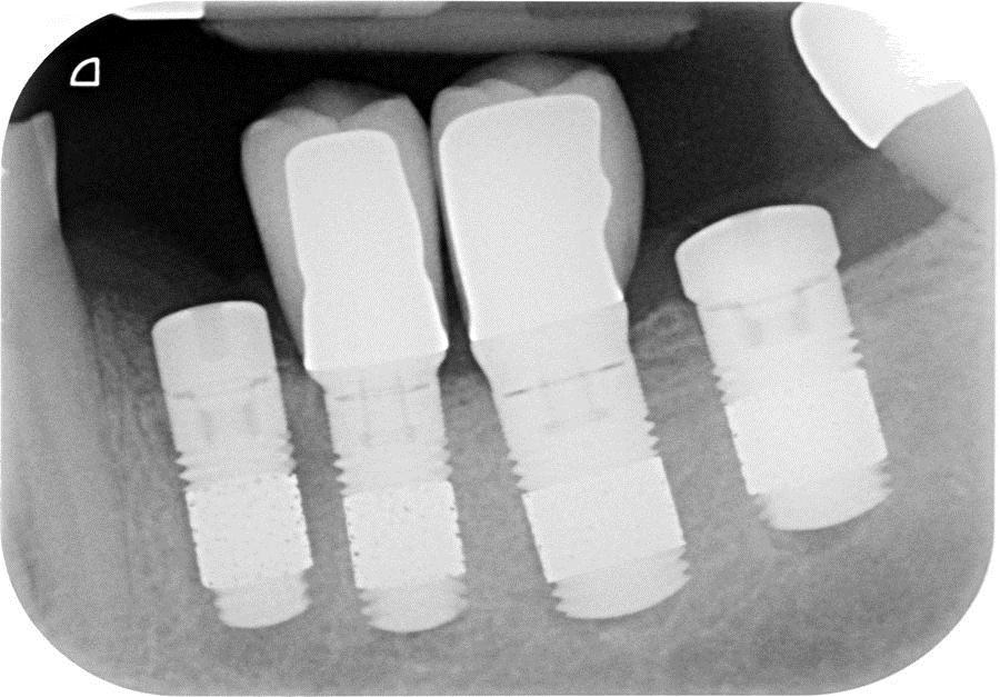 Dr. Markus Schlee Radiograph shows all four implants in place, with two