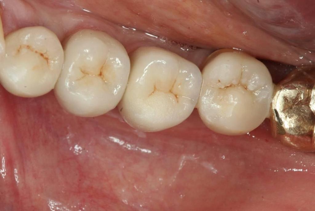 Dr. Markus Schlee Occlusal view of all four definitively restored implants after one