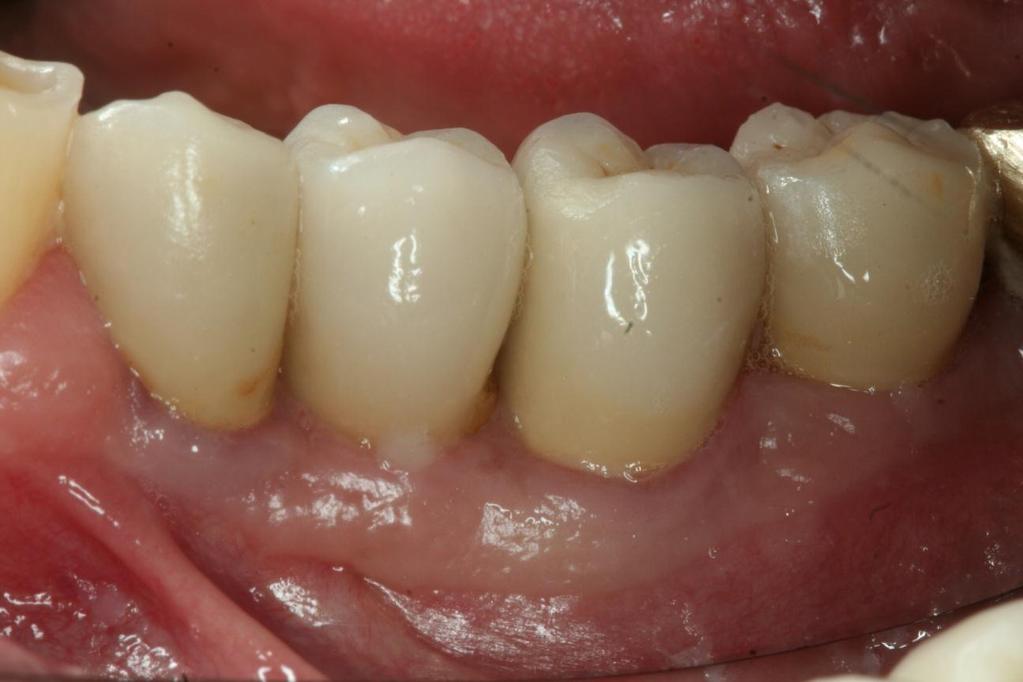 Dr. Markus Schlee Buccal view of four definitively restored implants