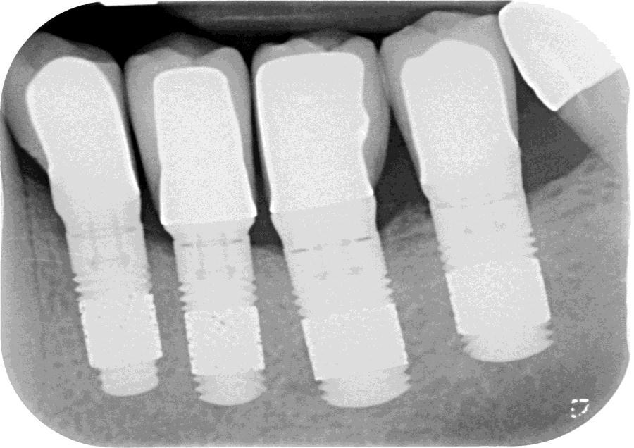 Dr. Markus Schlee Radiograph after one year