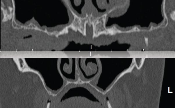 Dr. Carlo Maria Soardi Computed Tomography (CT) scans shows pneumatized sinuses with minimal