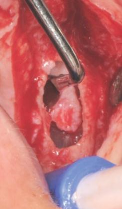 Dr. Carlo Maria Soardi The sinus cavity was accessed utilizing a crestal window approach according to the technique of Carlo M.