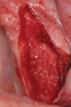 Dr. Carlo Maria Soardi Buccal view shows the bone graft material in place.