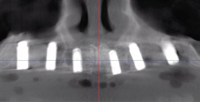 Dr. Carlo Maria Soardi Post-operative CT scan shows