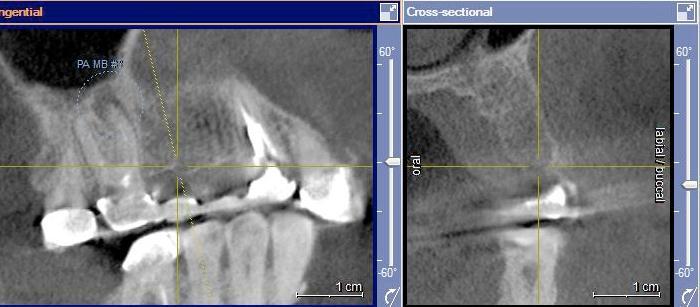 Dr. Edgard El Chaar CAT Scan of Patient A 60-year-old partially edentulous male with missing