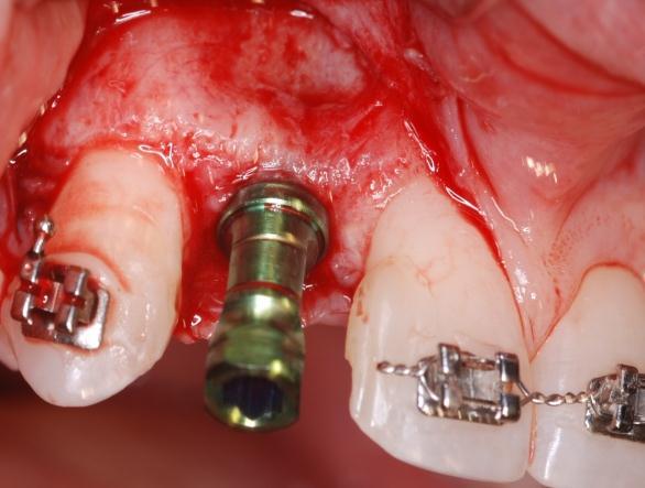 Buccal view shows the Zimmer Trabecular Metal Dental Implant fully seated in the