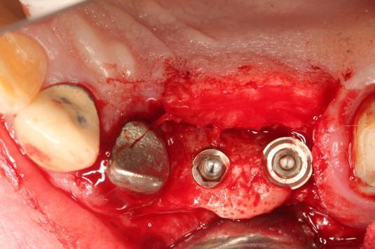 Dr. Edgard El Chaar Occlusal view of the surgical site shows a Tapered Screw-Vent Dental Implant, 3.