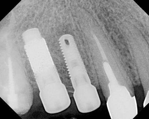 Dr. Edgard El Chaar Post-operative periapical radiographs show the Zimmer